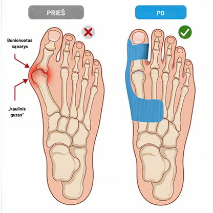 Kineziterapijas lente hallux valgus korekcijai un atbalstam