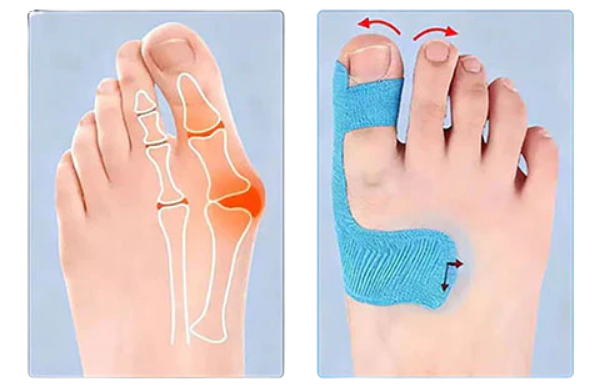 Kineziterapijas lente hallux valgus korekcijai un atbalstam
